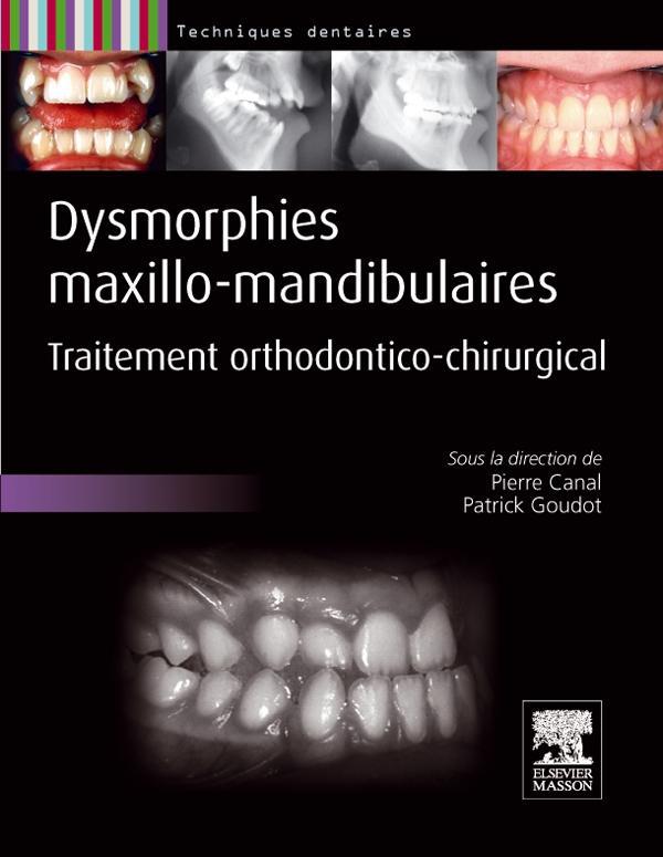 Dysmorphies maxillo-mandibulaires. Traitement orthodontico-chirurgical