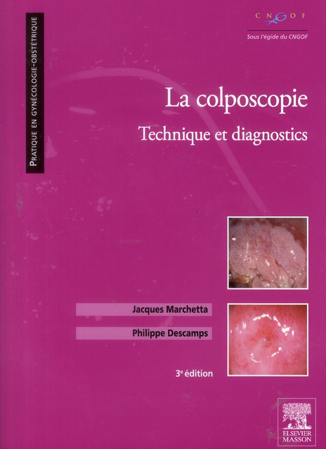 La colposcopie / Technique et diagnostics