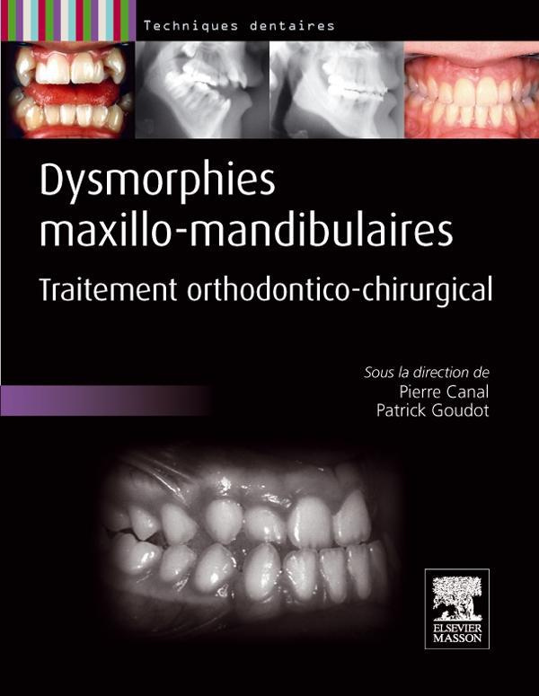 Dysmorphies maxillo-mandibulaires. Traitement orthodontico-chirurgical