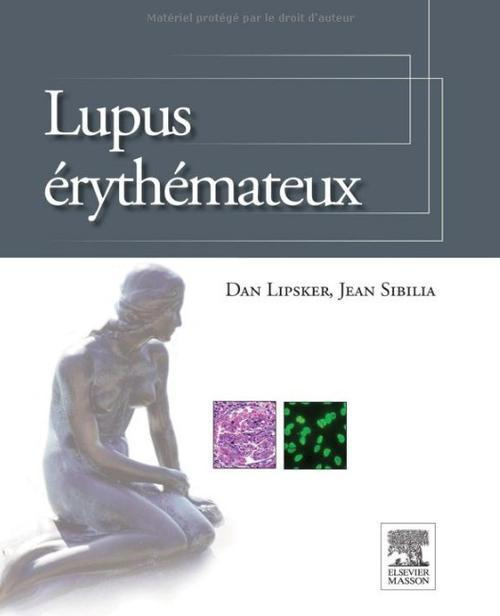 Lupus érythémateux