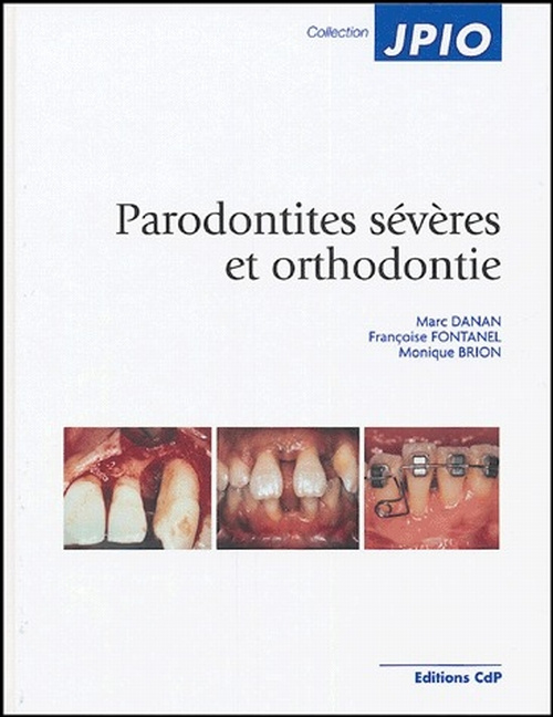 Parodontites sévères et orthodontie