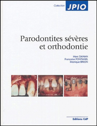 Parodontites sévères et orthodontie