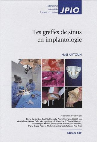 Les greffes de sinus en implantologie