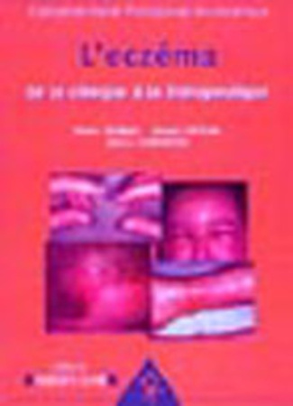 L'eczéma. De la clinique à la thérapeutique